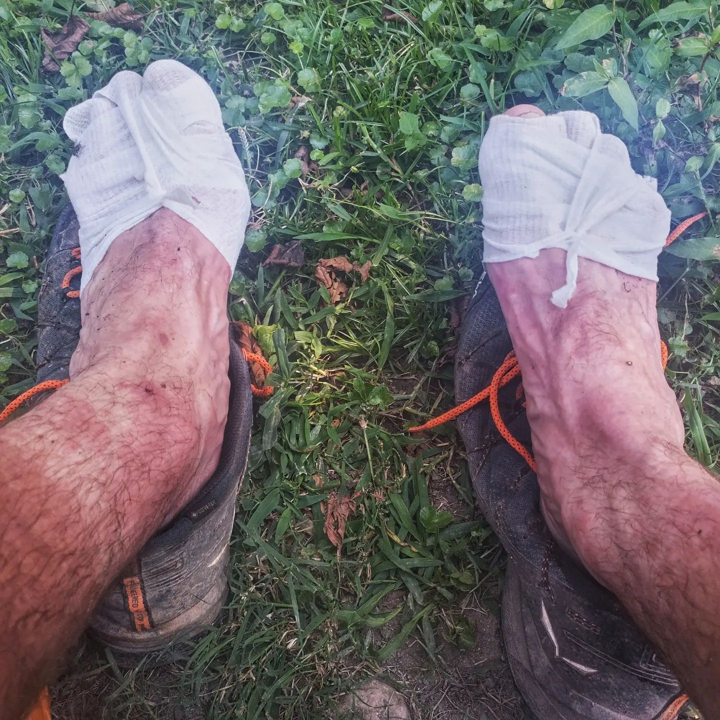 A photograph of bandaged feet.